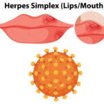 Domače zdravilo za herpes na ustnici