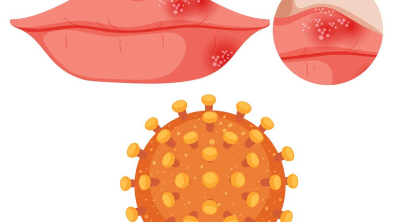 Domače zdravilo za herpes na ustnici