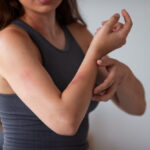 Srbenje kože po tuširanju